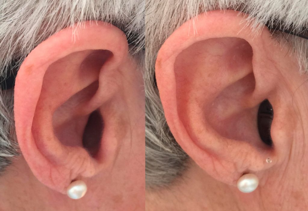 Links ohne In dem Ohr Hörgerät, rechts mit In dem Ohr Hörgerät